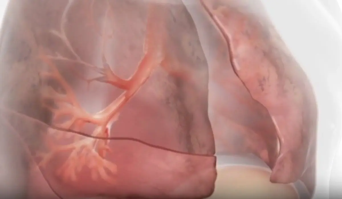 Innovazioni terapeutiche nella BPCO con enfisema Innovazioni terapeutiche nella BPCO con enfisema