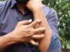 Studio Novartis, l’orticaria cronica spontanea costa 4.200 euro l’anno a paziente